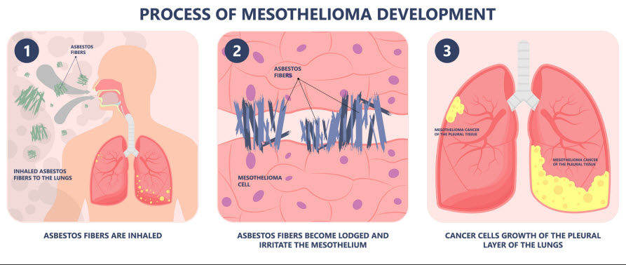 process of mesothelioma